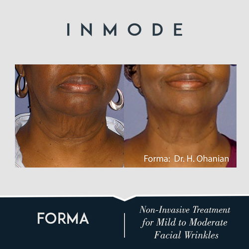 before and after forma treatment,Novocare Aesthetics Clinic, Calgary